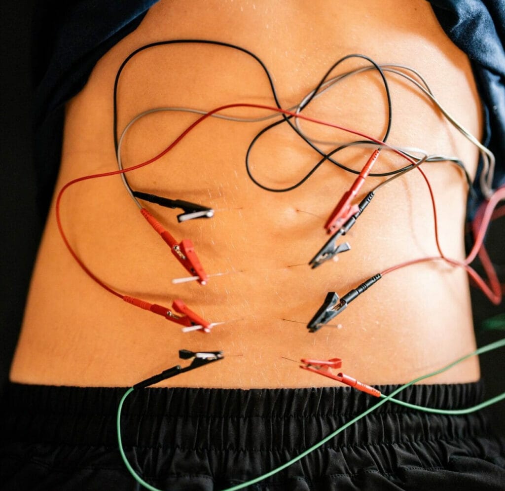 Dry needling therapy on a patient's back, targeting specific trigger points to relieve tension and enhance mobility.